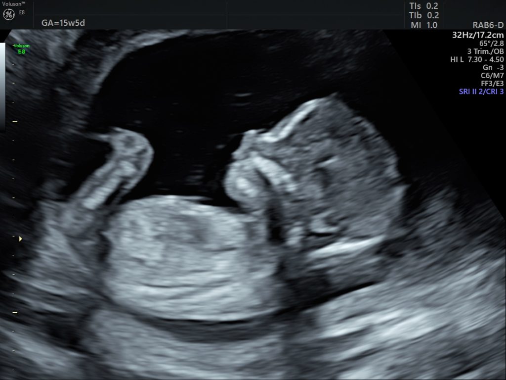 Dating Scan Radiop Pregnancy Reassurance & Dating Scan - Ultrasound Scanning Services