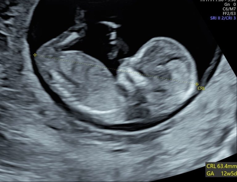 Pregnancy Reassurance & Dating Scan - Ultrasound Scanning Services