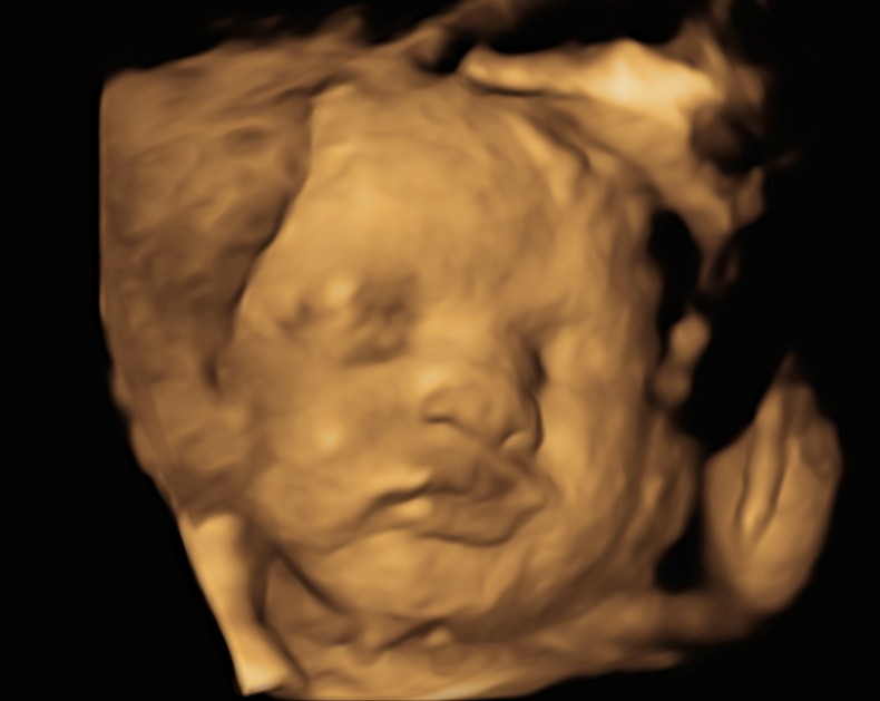 3D Colour Image at 20 Weeks