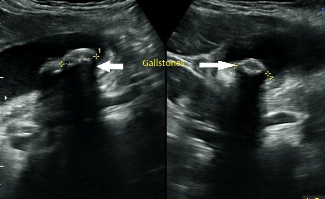 Abdomen scan showing gallstones