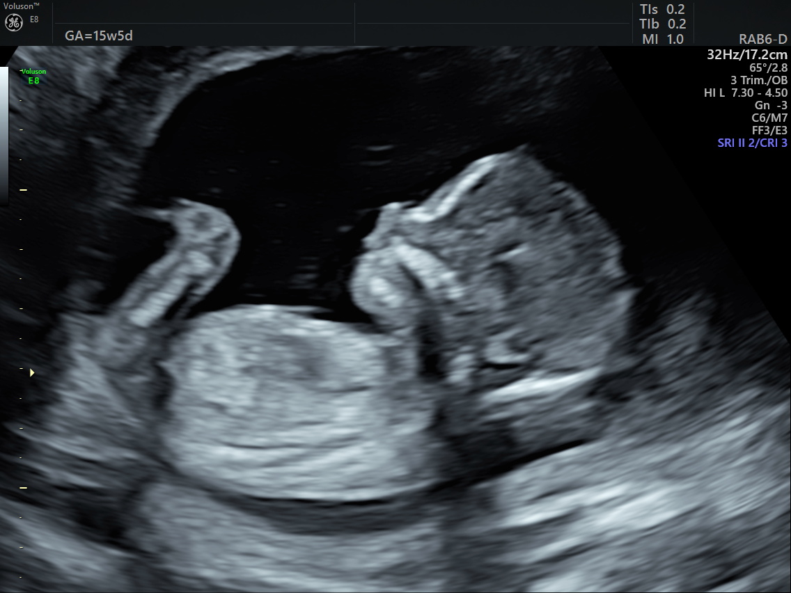 2D Black and White Image at 20 Weeks
