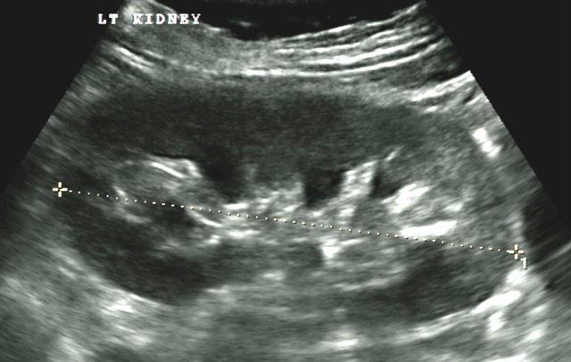 Kidneys, and Prostate - Ultrasound Services