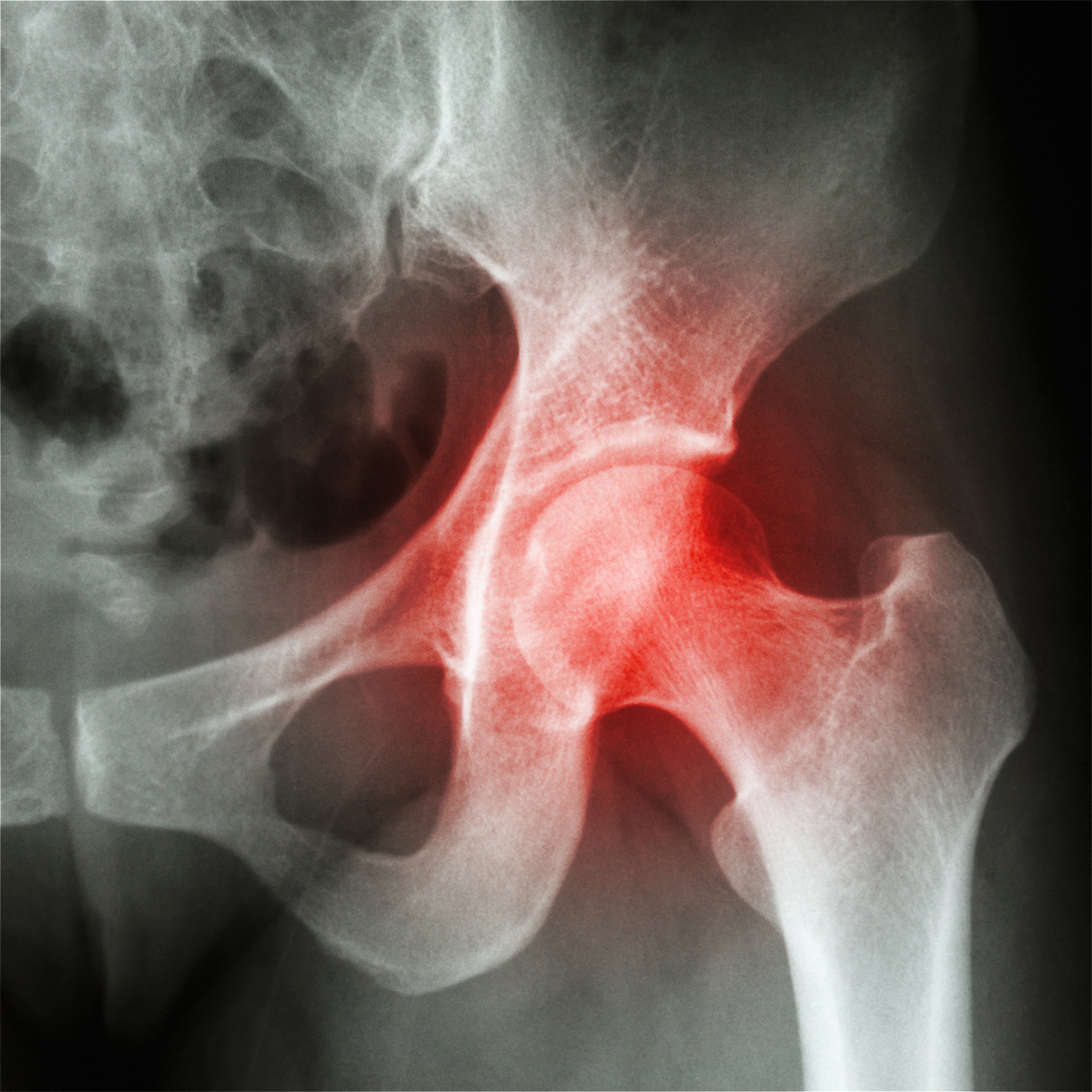 Musculoskeletal Hip and Groin