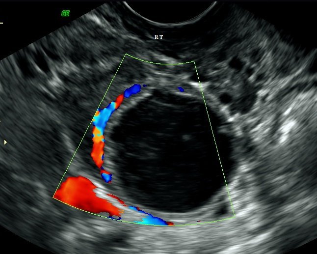 Pelvic Ovary Scan