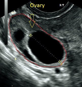 Pelvic Ovary Scan