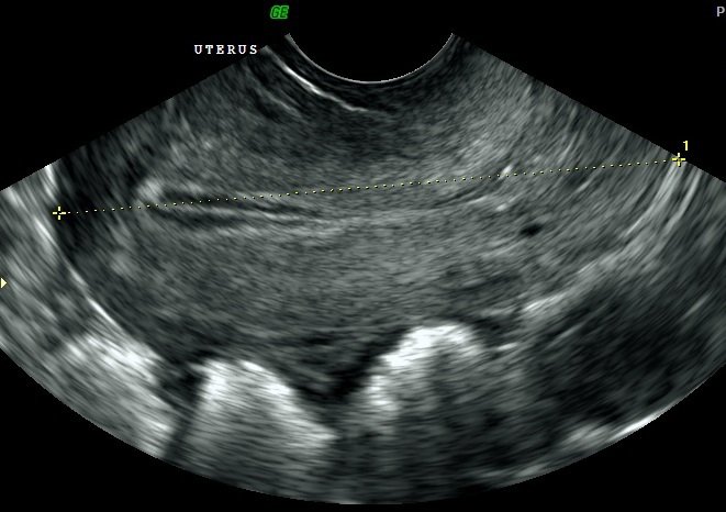 Pelvic Ovary Scan