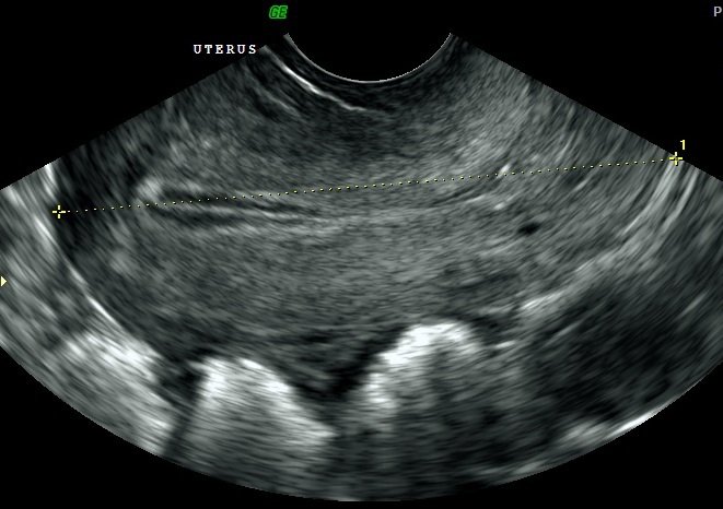 Pelvic Ultrasound Scans for Women in London - Ultrasound Services