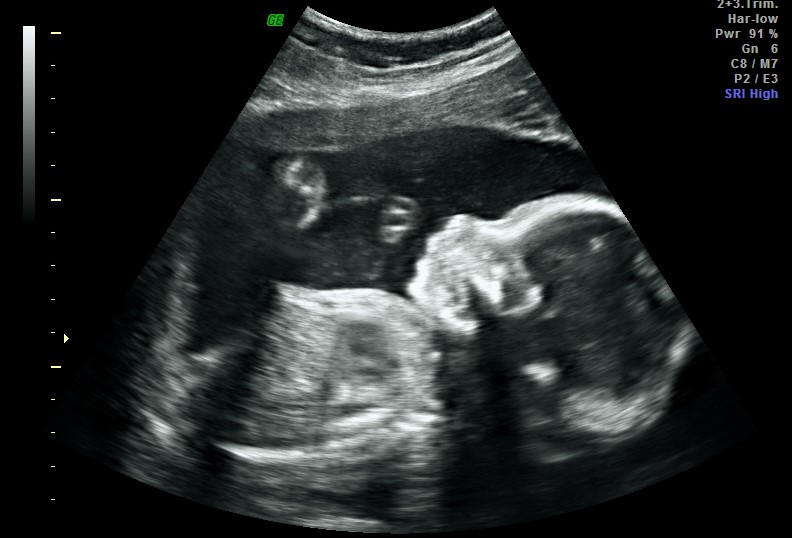 Pregnancy 2D Scan Week 24