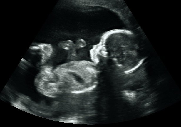 2D Black and White Image at 20 Weeks