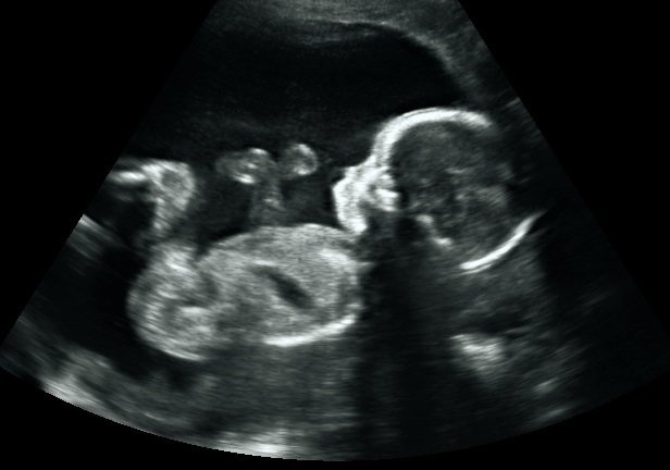 down syndrome baby ultrasound