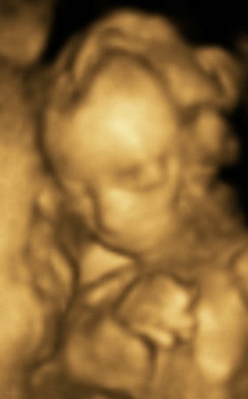 3D Colour Image at 20 Weeks